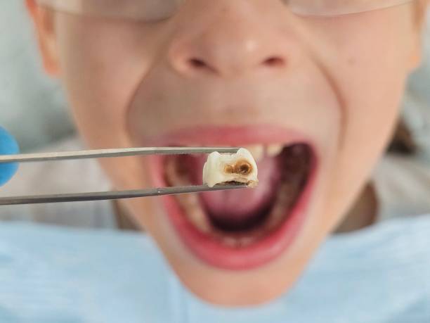 Best Urgent Care for Lost Fillings or Crowns in New Middletown, OH